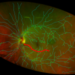 vesselTracking_retina_uwfv